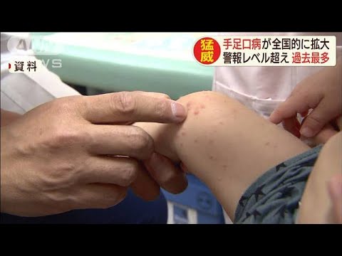 手足口病“警報レベル”超え　全国的に流行拡大(19/07/02) - YouTube