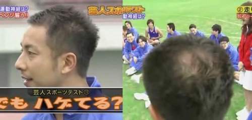 テレビでもネタにされるハゲ頭
