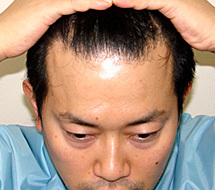 「ハゲ迫」と呼ばれていた過去