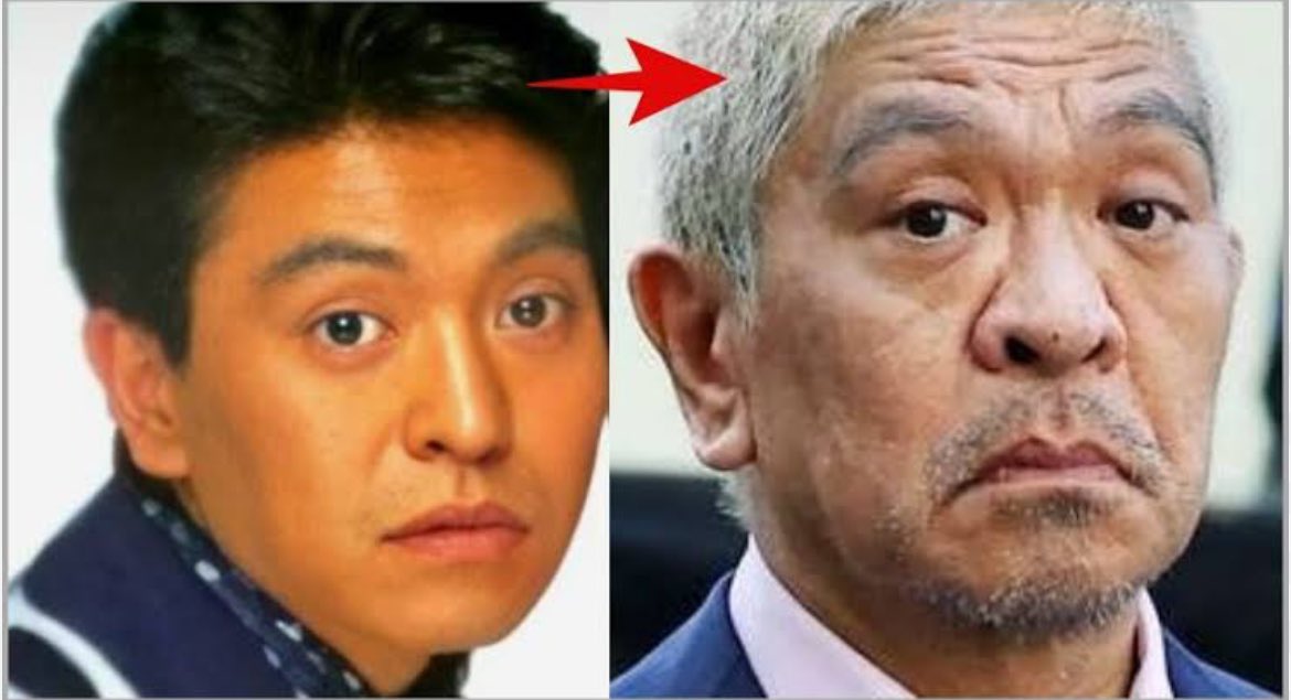 加齢による鼻肥大の典型例